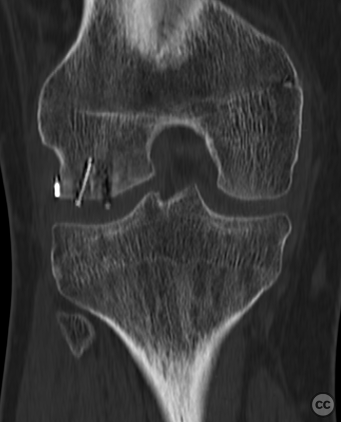Destructive Osteochondral Fracture Of The Lateral Femoral Condyle Following Traumatic Patella
